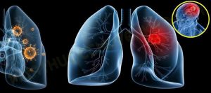 Ung thư phổi là gì?