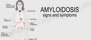Bệnh Amyloidosis là bệnh gì?